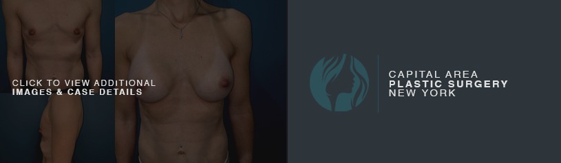 https://capsny.com/wp-content/uploads/2019/09/CAPSNY_CASE_STUDIES_Breast-Augmentation-Explanation-of-Implant-Size-Selection.jpg