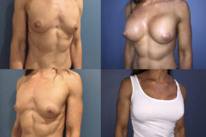 CASE_STUDIES_Bilateral-Breast-Augmentation