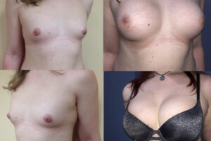 CASE_STUDIES_Breast-Augmentation-Gender-Reassignment