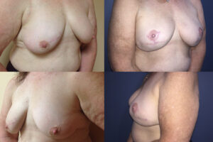 CASE_STUDIES_Breast-Reconstruction-After-Horizontal-Scar-Mastectomy